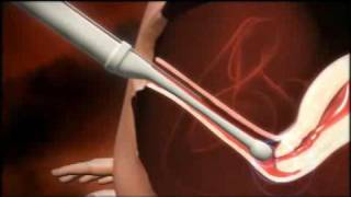 3D animation of how IVF works [upl. by Nerad]