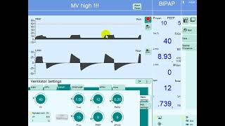 Volume Control vs Pressure Control on Mechanical Ventilation [upl. by Maisel635]