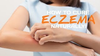 How To Cure Eczema Naturally [upl. by Htedirem]