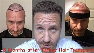 HAIR TRANSPLANT in ISTANBUL  8 months on WET HAIR  how does it LOOK Stop taking MINOXIDIL [upl. by Eillim327]