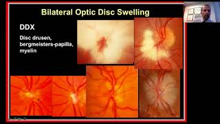 Approach to the Patient with Bilateral Optic Disc Swelling [upl. by Learsiy]