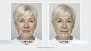 Dysport Restylane and Lyft Fillers Testimonials by Manufacturer Galderma  Pittsburgh Pa [upl. by Itch]