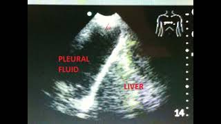 hoovers sign in copd due to increasing intrathoracic negative pressure [upl. by Ishmul]