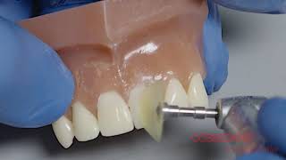 How to Achieve a High Luster on your Composite Restorations [upl. by Mccullough]