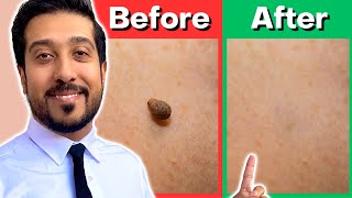 How to Remove Skin Tags Yourself AT HOME  Get Rid of Skin Tags NOW [upl. by Milissent]