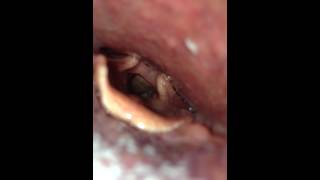 Vocal Cord Polyp [upl. by Byrd203]