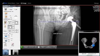 Radlink3D Intra Op 3D Software for Hip Implant Positioning [upl. by Oneg]