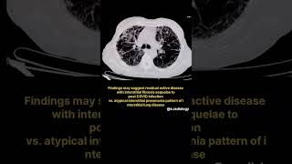 HRCT THORAX FINDINGS SHORT VIDEO [upl. by Kampmann]