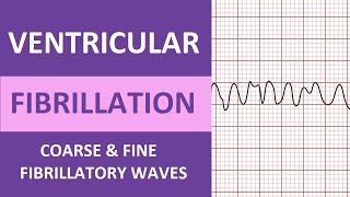 Ventricular Fibrillation VFib ECG Interpretation Nursing Heart Rhythms NCLEX ACLS [upl. by Ibmat]