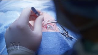 Strabismus Eye Surgery  Inside the OR [upl. by Elesig]