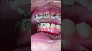 Orthodontic Bite Plate and Braces  When I get my bottom braces Tooth Time Family Dentistry Texas [upl. by Ebby]