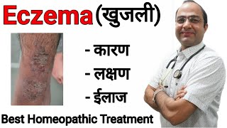 Eczema  Atopic Dermatitis  खाज खुजली । Skin allergy best treatment [upl. by Ailhad700]