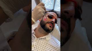 Depilación Laser  Marcación de Barba y espalda  Laser Fotona [upl. by Adne]