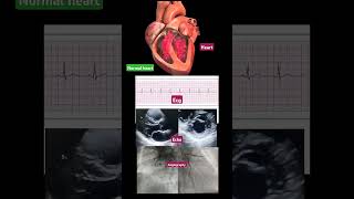 Normal ECG ECHO Angiography  Normal Heart Animation echo  short  video ▶️ [upl. by Oigroig85]