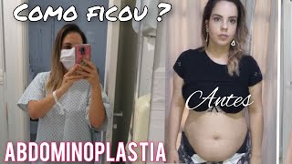 MOSTREI MEU CORPO 3 MESES APÓS ABDOMINOPLASTIA 5 [upl. by Aihsekel319]