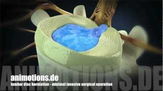 Herniation quotlumbarquot Treatment Surgery 3D Animation [upl. by Tada9]