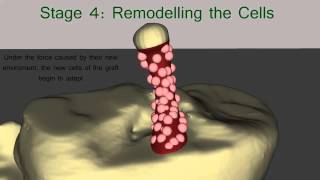 The Healing Process of the ACL Graft [upl. by Harald]