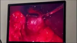 Difficult laparoscopic cholecystectomy with adhesive transverse colon [upl. by Wershba]