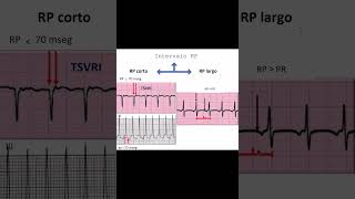 Cómo Identificar Tipos de Taquicardia en el Electrocardiograma  Dr Jose Porto [upl. by Feetal]