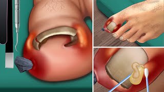 ASMR Ingrown toenail  Treatment corner of the toenail  Beautiful pedicure for girls [upl. by Delora]