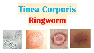 Ringworm Tinea Corporis  Causes Risk Factors Signs amp Symptoms Diagnosis and Treatment [upl. by Alaet]