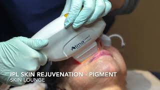 IPL Skin Rejuvenation for pigmentation [upl. by Eetsirk]