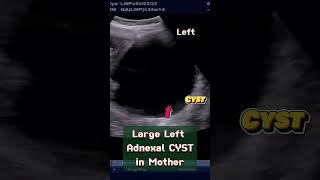 Large Ovarian Cyst in Mother with Normal Pregnancy of 33 wks ultrasound pregnancy baby [upl. by Tansey]