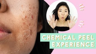 ✂ Chemical Peel for Acne amp Scars Before amp After [upl. by Sibyls]