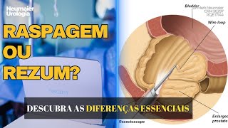 RASPAGEM OU REZUM Descubra as diferenças ESSENCIAIS [upl. by Any]