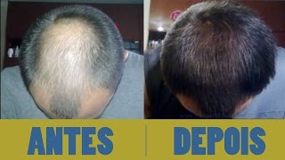 Antes e depois  Minoxidil Kirkland  Cabelo  6 Meses [upl. by Mirielle]