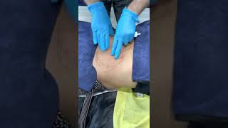 Fat Dissolving Injection to Belly [upl. by Abbye]