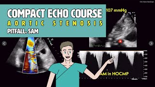 〖Echocardiography〗 LVOT obstruction amp SAM  pitfalls in aortic stenosis 🚨 [upl. by Liesa662]