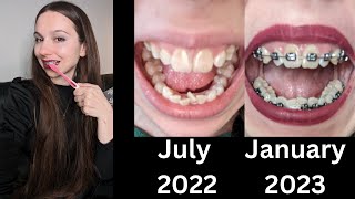 6 MONTH ADULT BRACES UPDATE🦷Progress First Dental Visit with Braces Current Routine  More [upl. by Loftus]