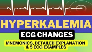 Hyperkalemia ECG Changes Interpretation Mnemonics and Hyperkalemia ECG Examples [upl. by Aiuqcaj]