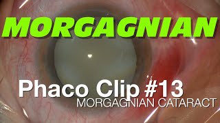 Phaco Clip 13  Morgagnian Cataract [upl. by Ahsitam]