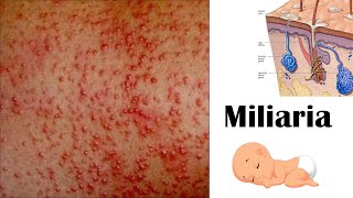 Miliaria Heat Rash  Types Causes Signs amp Symptoms amp Treatment [upl. by Iror116]