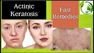 Actinic keratosis Causes and Natural Treatments [upl. by Annahs440]