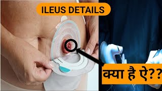 understanding ILEUS [upl. by Arval]