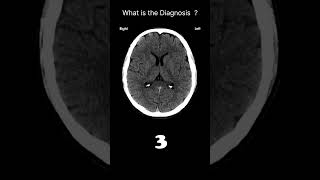 Internal capsules CT brain CT Brain Anatomy White matter structures Quiz 27 radiologychannel007 [upl. by Alcock]