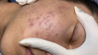 ACNE TREATMENT VU QUYNH MI Acne On Boys Chin 2024 [upl. by Lilahk]