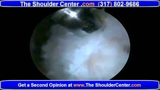 Second Shoulder Surgery  How to Approach a 2nd Rotator Cuff Surgery [upl. by Notsek]