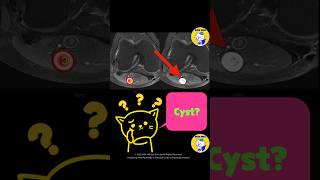 Fig 4D19 Schwannoma [upl. by Witherspoon]