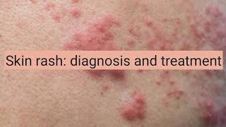 Skin Rash diagnosis and treatment [upl. by Adella]