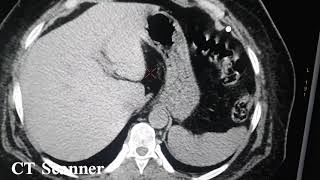 lithiase rénal TDM Abdominale sans injection [upl. by Tisbe508]