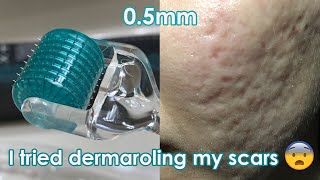 I tried dermarolling my ACNE SCARS  Demo  Review [upl. by Darnok]