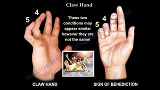 Claw Hand Ulnar Claw Hand  Everything You Need To Know  Dr Nabil Ebraheim [upl. by Aimaj]