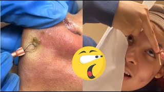 Ultimate Satisfying Blackhead Removal Compilation  Relaxing Skincare Routine [upl. by Joella]