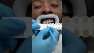 Watch this teeth whitening process dentist shorts teethwhitening [upl. by Koppel]