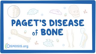 Paget Disease of Bone radiology doctor bones [upl. by Gearard636]