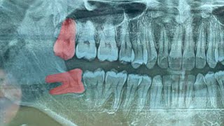 Removal Of 2 Wisdom Teeth At Once  Odontectomy  Geraham Bungsu  Dentist  Dokter Gigi Tri Putra [upl. by Batory]